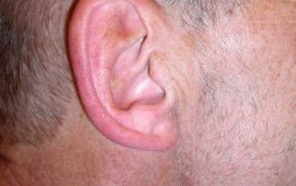 Abstehende Ohren Korrektur 1e vorher Bild Dr Sylvester M Maas