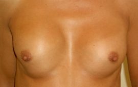 Implantatwechsel Brust 2a vorher Bild Dr Sylvester M Maas