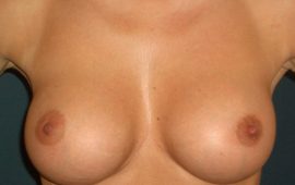 Brustvergrösserung rundes Implantat 2d nachher Bild Dr Sylvester M Maas