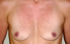 Brustvergroesserung rundes Implantat 39a Vorher Bild Dr Sylvester M Maas