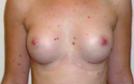 Brustvergrösserung rundes Implantat 42d post op foto Dr Sylvester M Maas