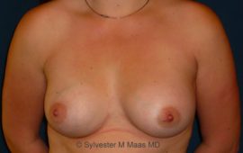 Brustimplantat Wechsel 3d nachher Bild Dr Maas