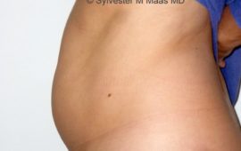 Liposuction 7c before foto Dr Sylvester M Maas
