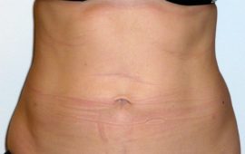 Liposuction 7d after foto Dr Sylvester M Maas