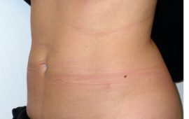 Liposuction 7e after foto Dr Sylvester M Maas