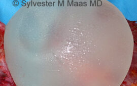 silikon bleeding breastimplant 1 dr sylvester m maas plastic surgeon zug
