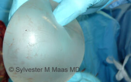 silikon bleeding breastimplant 2 dr sylvester m maas plastic surgeon zug