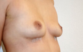 Brustimplantat Entfernung 2f Nachher Bild Dr Sylvester M Maas Zug
