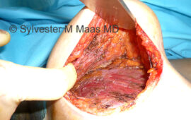 brustimplantat hohlraum pre pectoral dr sylvester m maas plastic surgeon zug