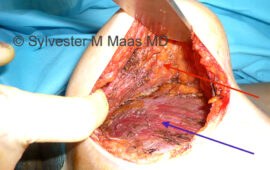 brustimplantat-hohlraum-pre-pectoral-dr-sylvester-maas-plastic-surgeon-zug