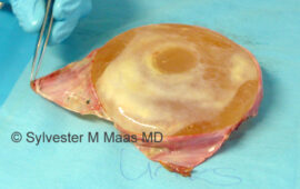 doppelt kapsel brustimplantat 1a en bloc explant-dr sylvester m maas plastic surgeon zug