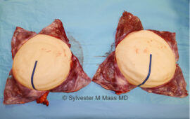 Implantate nach En Bloc Brustimplantat Entfernung 2a Dr Sylvester M Maas Zug