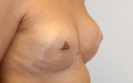 En Bloc Brustimplantat Entfernung Bruststraffung 3h Nachher Bild Dr Sylvester M Maas Zug