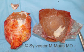 Kalk in der Kapsel en bloc explant brustimplantat 5a dr sylvester m maas plastic surgeon zug