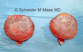 en bloc explant brustimplantat 5b dr sylvester m maas plastic surgeon zug