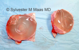 en bloc explant brustimplantat 5d dr sylvester m maas plastic surgeon zug