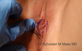 Schamlippenverkleinerung 2b Vorher Bild Dr Maas Plastische Chirurgie Zug