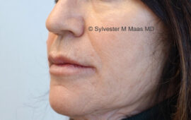 unterspritzung-mund-hyaluron-1d-nachher-dr-maas-plastische-chirurgie-zug
