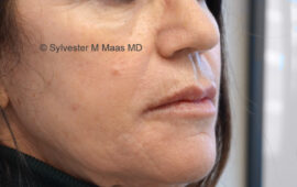 unterspritzung-mund-hyaluron-1f-nachher-dr-maas-plastische-chirurgie-zug